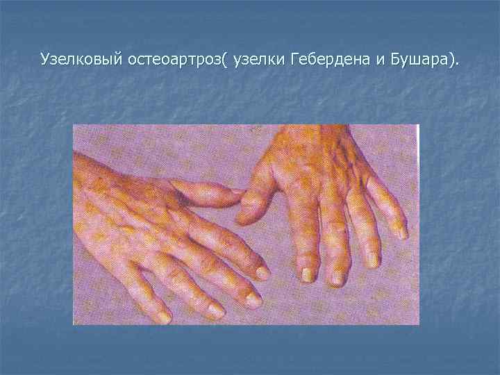 Узелковый остеоартроз( узелки Гебердена и Бушара). 