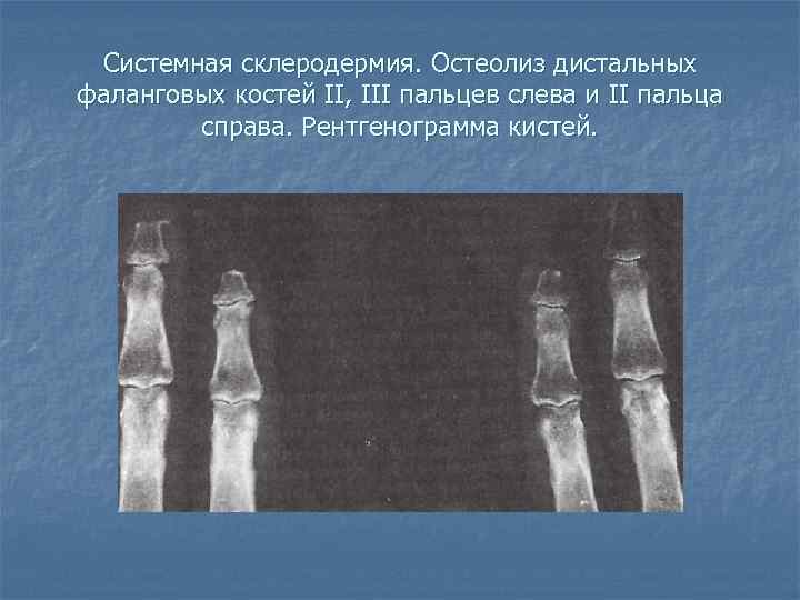 Системная склеродермия. Остеолиз дистальных фаланговых костей II, III пальцев слева и II пальца справа.