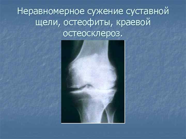 Неравномерное сужение суставной щели, остеофиты, краевой остеосклероз. 