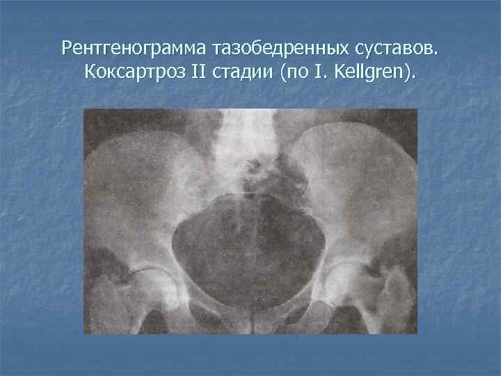 Рентгенограмма тазобедренных суставов. Коксартроз II стадии (по I. Kellgren). 
