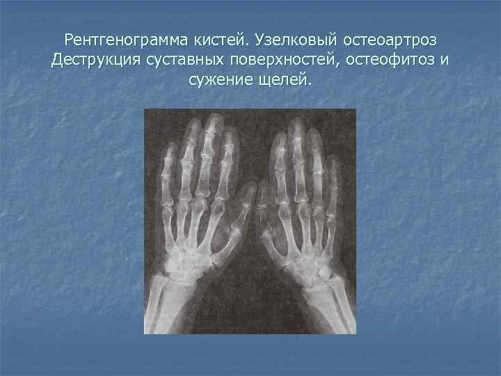 Рентгенограмма кистей. Узелковый остеоартроз Деструкция суставных поверхностей, остеофитоз и сужение щелей. 
