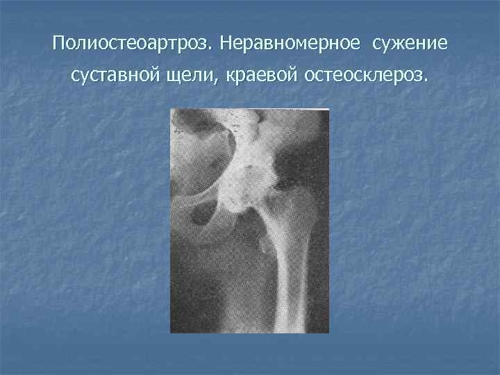 Полиостеоартроз. Неравномерное сужение суставной щели, краевой остеосклероз. 