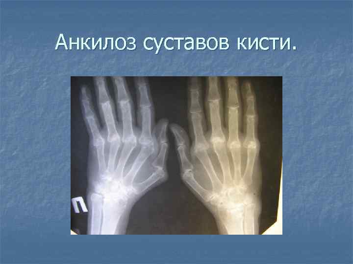 Анкилоз суставов кисти. 
