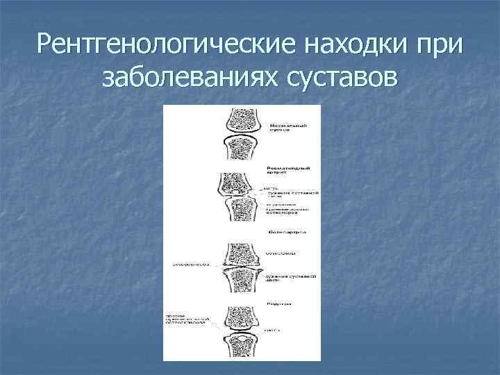 Рентгенологические находки при заболеваниях суставов 