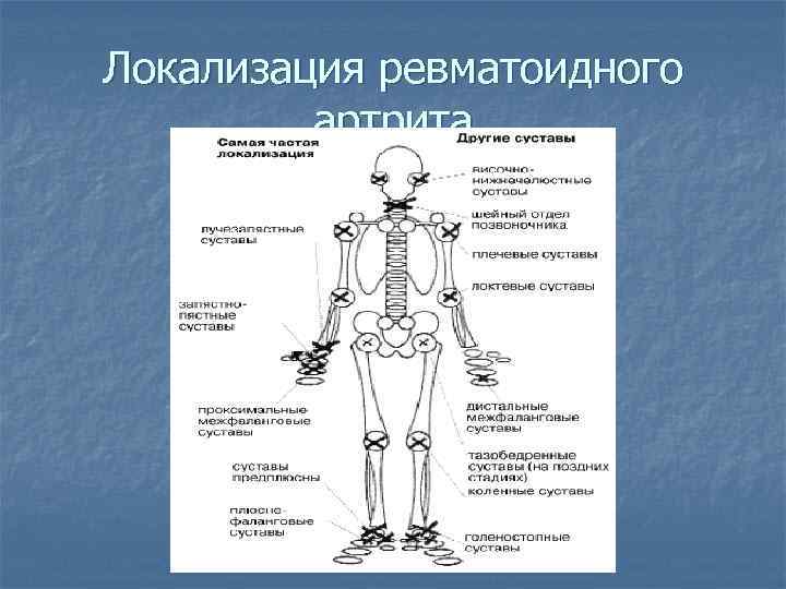 Локализация ревматоидного артрита 