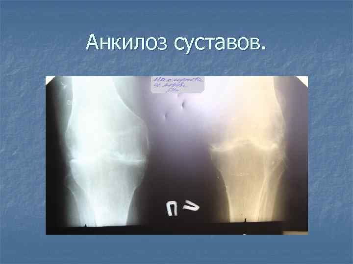 Анкилоз суставов. 