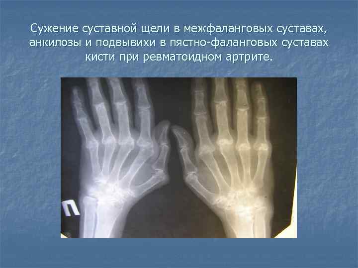Сужение суставной щели в межфаланговых суставах, анкилозы и подвывихи в пястно-фаланговых суставах кисти при