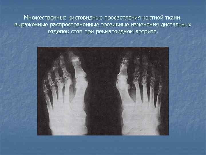 Единичное кистовидное просветление