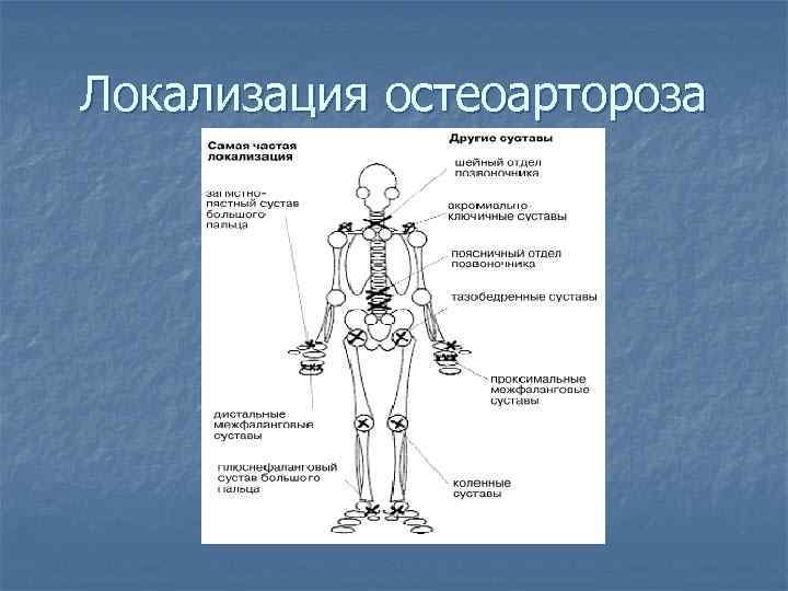 Локализация остеоартороза 