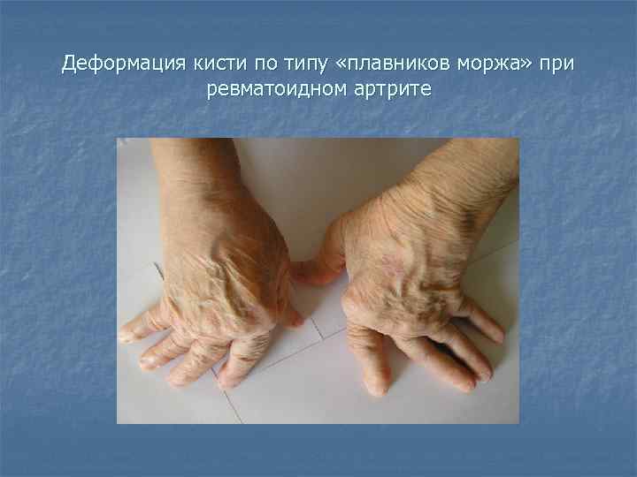Деформация кисти по типу «плавников моржа» при ревматоидном артрите 