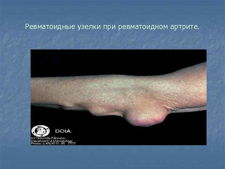 Ревматоидные узелки при ревматоидном артрите. 
