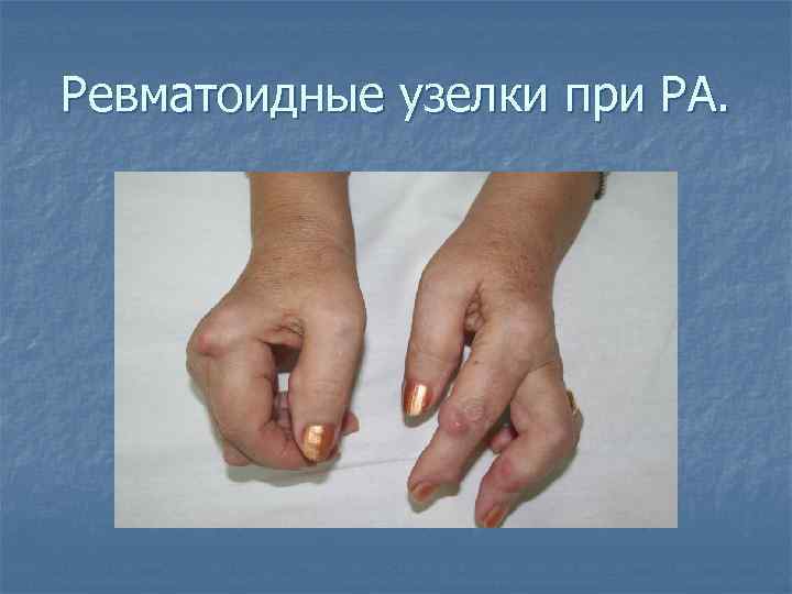 Ревматоидные узелки при РА. 