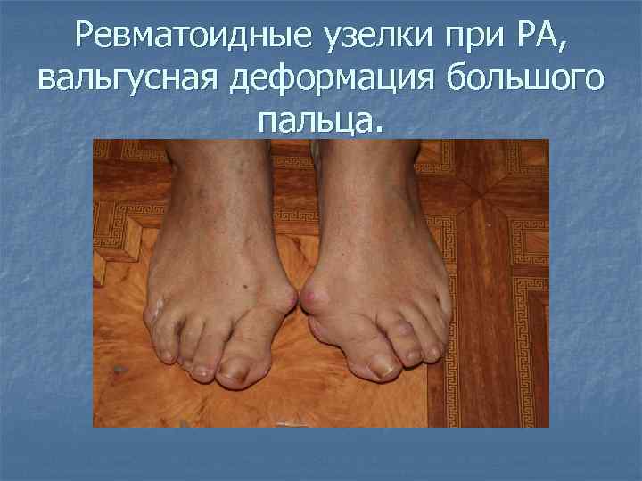 Ревматоидные узелки при РА, вальгусная деформация большого пальца. 
