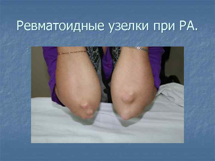 Ревматоидные узелки при РА. 