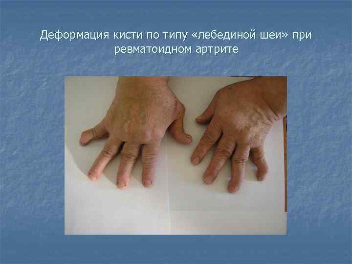 Деформация кисти по типу «лебединой шеи» при ревматоидном артрите 