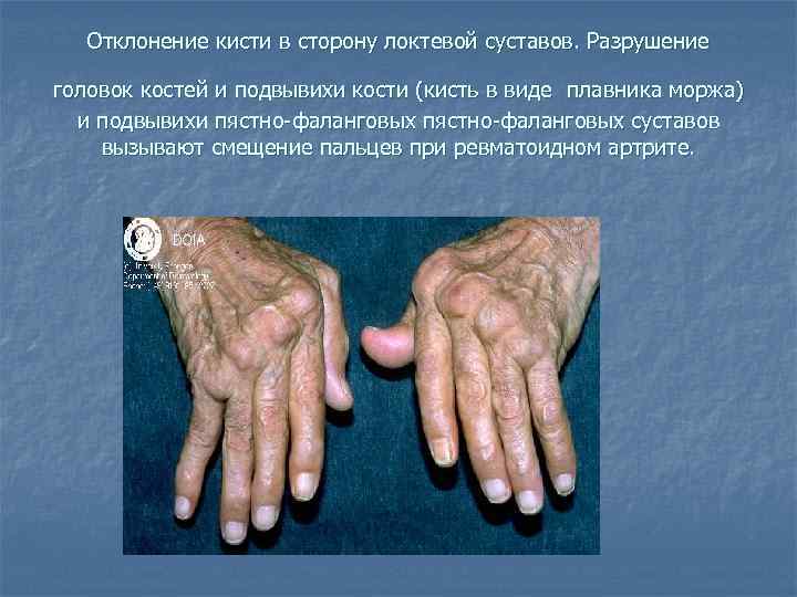 Отклонение кисти в сторону локтевой суставов. Разрушение головок костей и подвывихи кости (кисть в