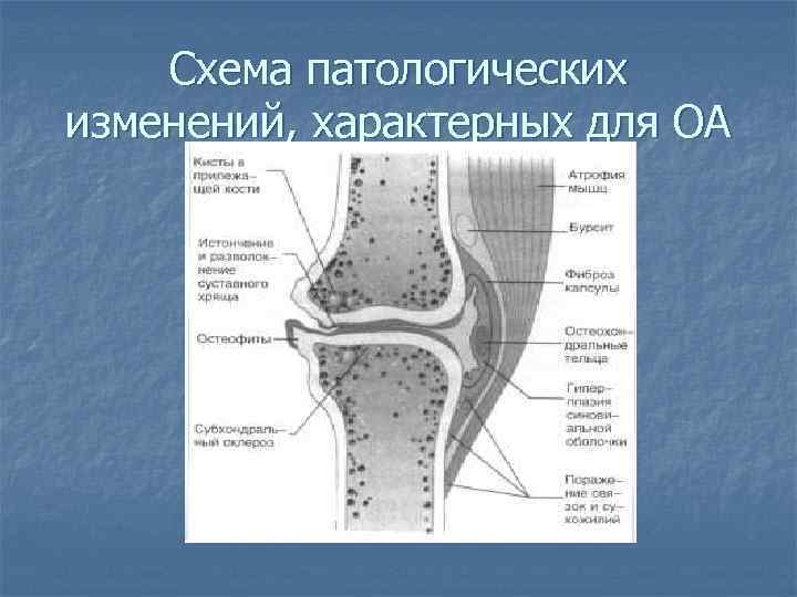 Схема патологических изменений, характерных для ОА 