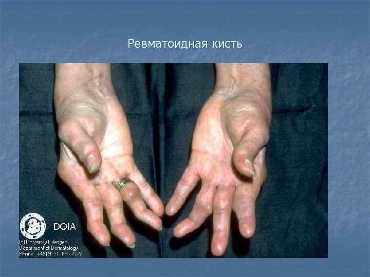 Ревматоидная кисть 