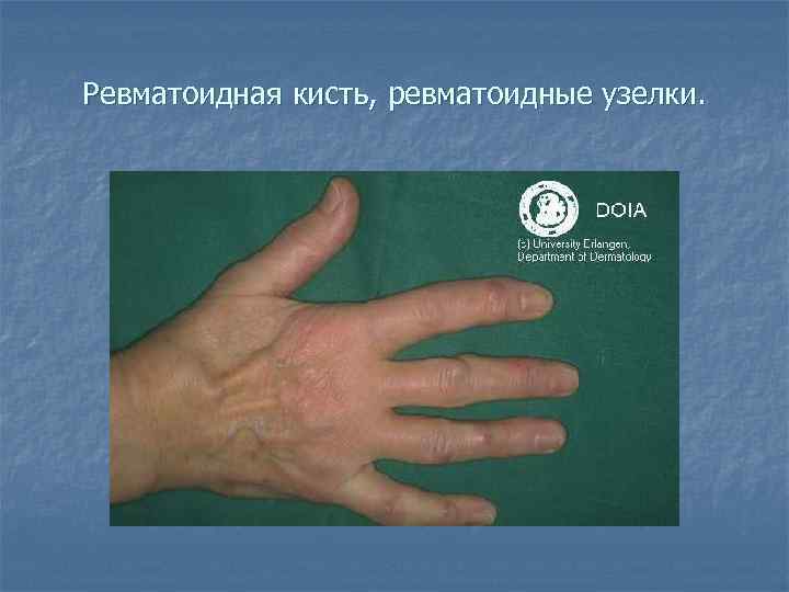 Ревматоидная кисть, ревматоидные узелки. 