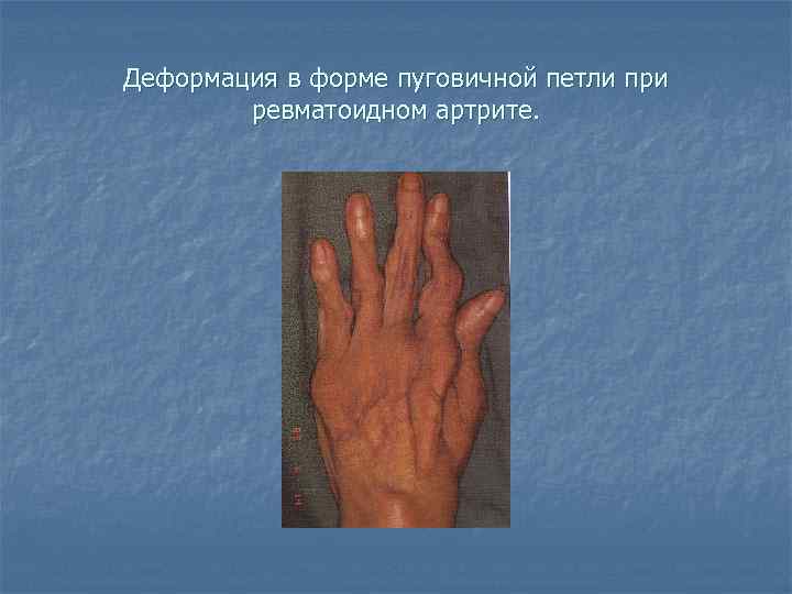Деформация в форме пуговичной петли при ревматоидном артрите. 