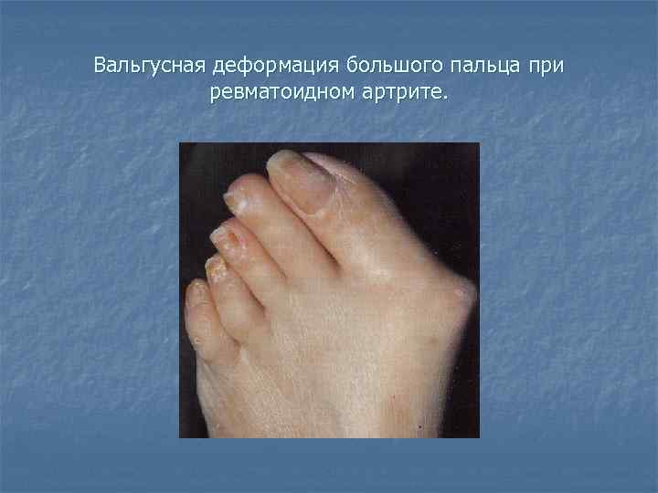 Вальгусная деформация большого пальца при ревматоидном артрите. 