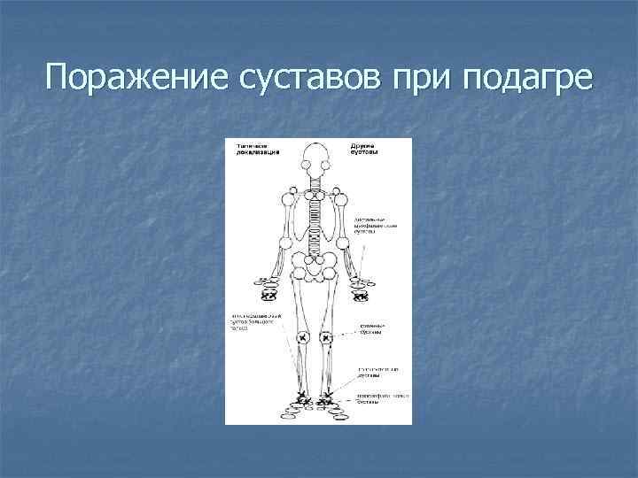 Поражение суставов при подагре 