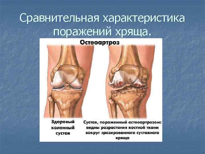Сравнительная характеристика поражений хряща. 