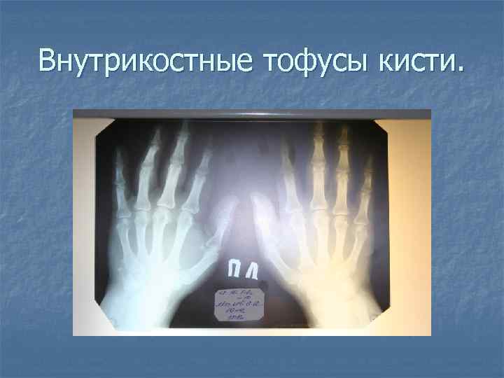 Внутрикостные тофусы кисти. 