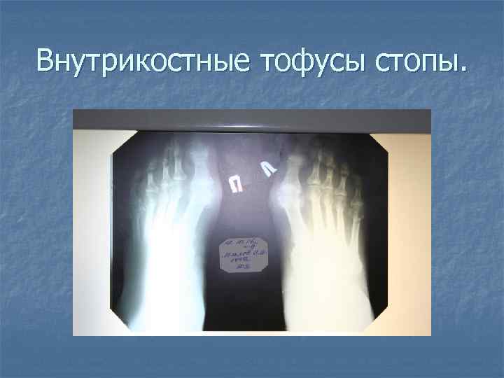 Внутрикостные тофусы стопы. 