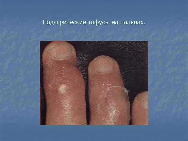 Подагрические тофусы на пальцах. 