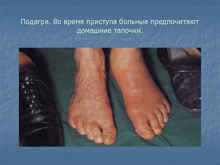 Подагра. Во время приступа больные предпочитают домашние тапочки. 
