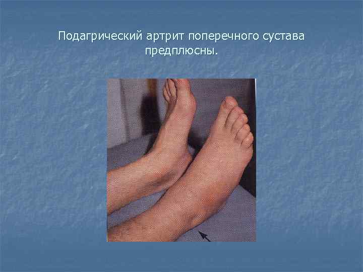Подагрический артрит поперечного сустава предплюсны. 