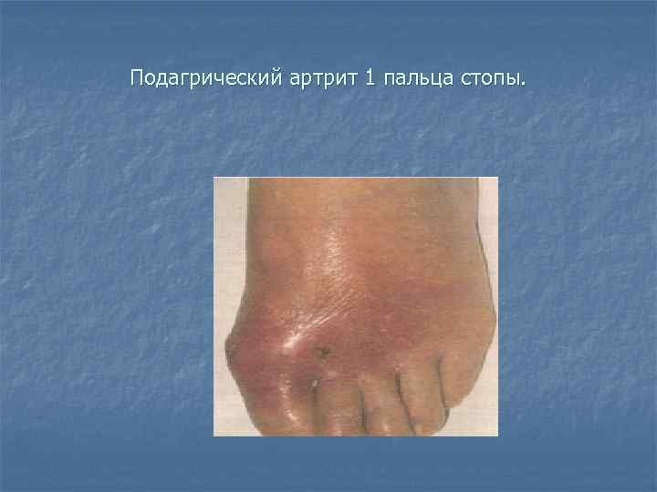 Подагрический артрит 1 пальца стопы. 