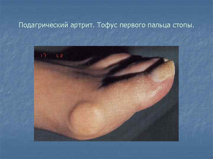 Подагрический артрит. Тофус первого пальца стопы. 