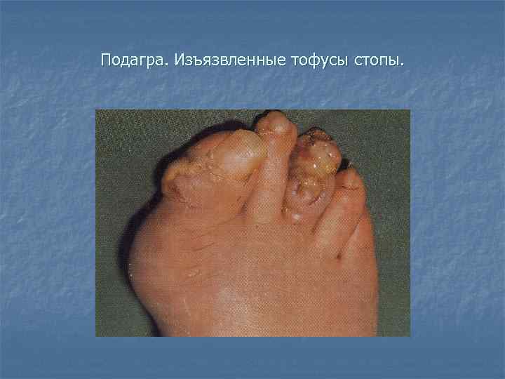 Подагра. Изъязвленные тофусы стопы. 