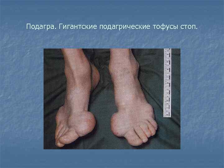 Подагра. Гигантские подагрические тофусы стоп. 