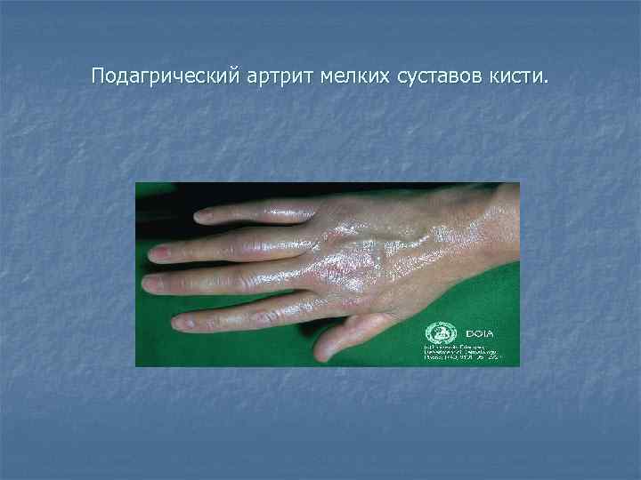 Подагрический артрит мелких суставов кисти. 