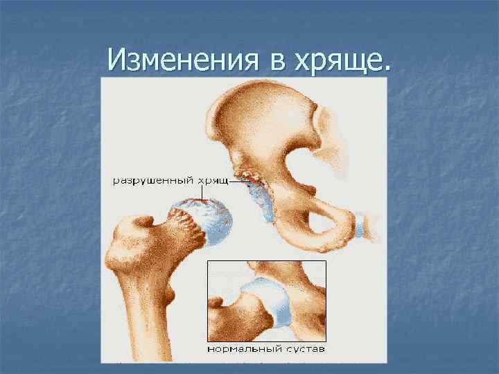 Изменения в хряще. 