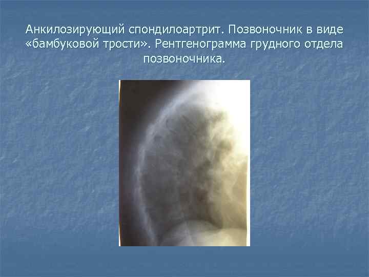 Анкилозирующий спондилоартрит. Позвоночник в виде «бамбуковой трости» . Рентгенограмма грудного отдела позвоночника. 