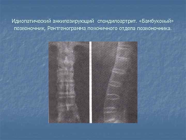 Идиопатический анкилозирующий спондилоартрит. «Бамбуковый» позвоночник, Рентгенограмма поясничного отдела позвоночника. 