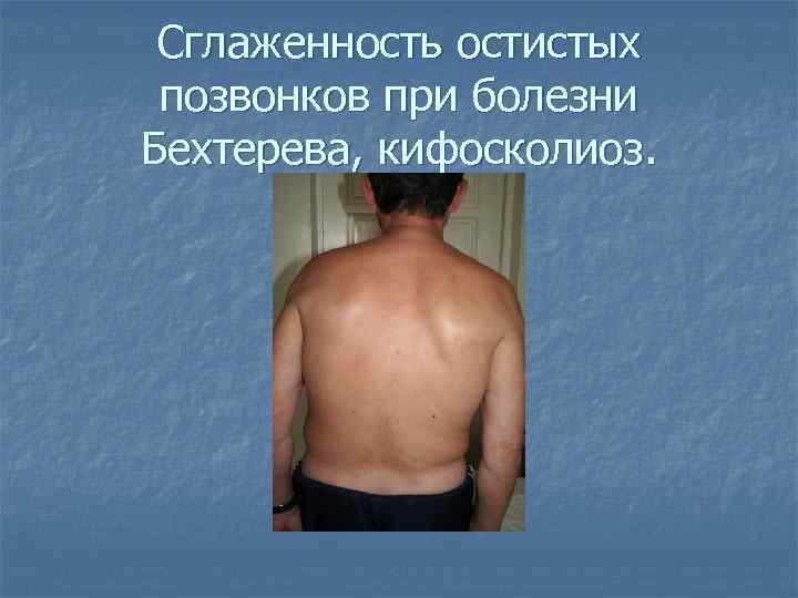 Сглаженность остистых позвонков при болезни Бехтерева, кифосколиоз. 