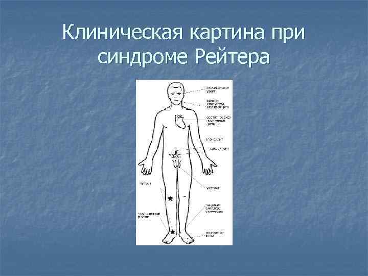Клиническая картина при синдроме Рейтера 