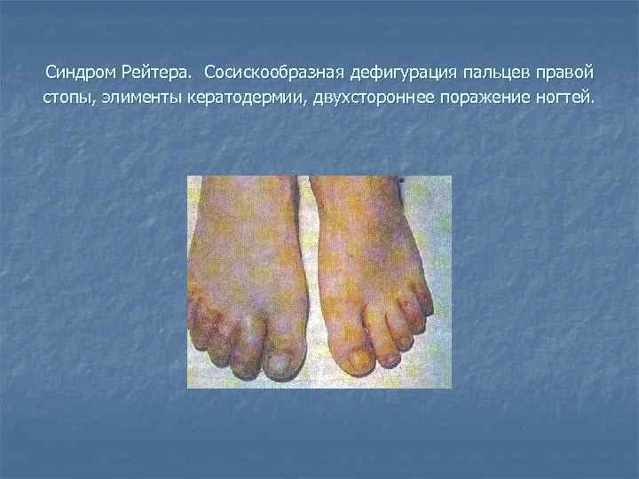 Синдром Рейтера. Сосискообразная дефигурация пальцев правой стопы, элименты кератодермии, двухстороннее поражение ногтей. 