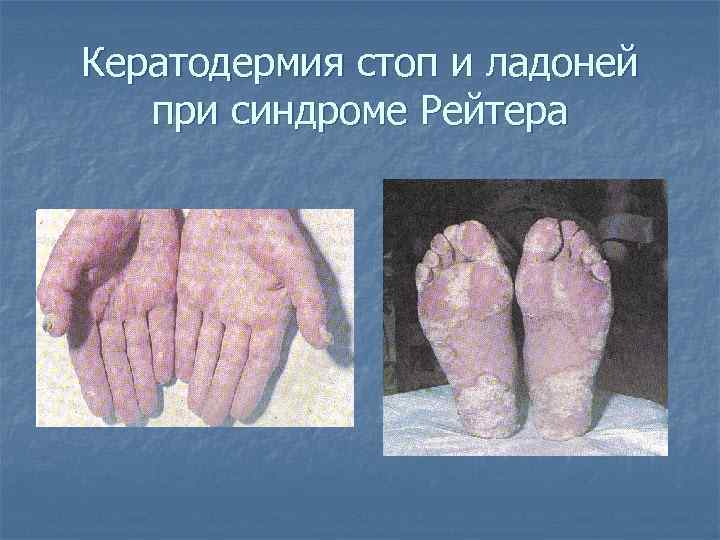 Кератодермия стоп и ладоней при синдроме Рейтера 