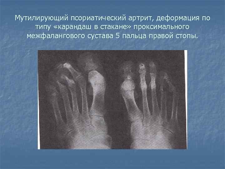 Мутилирующий псориатический артрит, деформация по типу «карандаш в стакане» проксимального межфалангового сустава 5 пальца