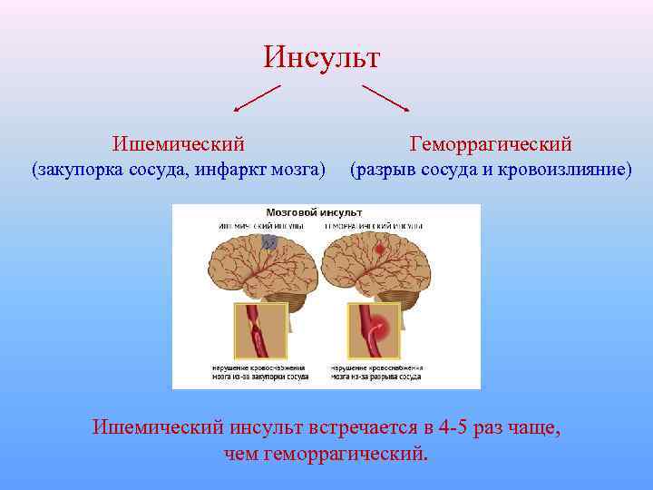 Инсульт Ишемический Геморрагический (закупорка сосуда, инфаркт мозга) (разрыв сосуда и кровоизлияние) Ишемический инсульт встречается