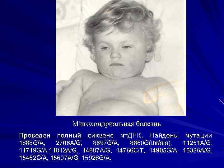 Митохондриальная болезнь Проведен полный сиквенс мт. ДНК. Найдены мутации 1888 G/A, 2706 A/G, 8697