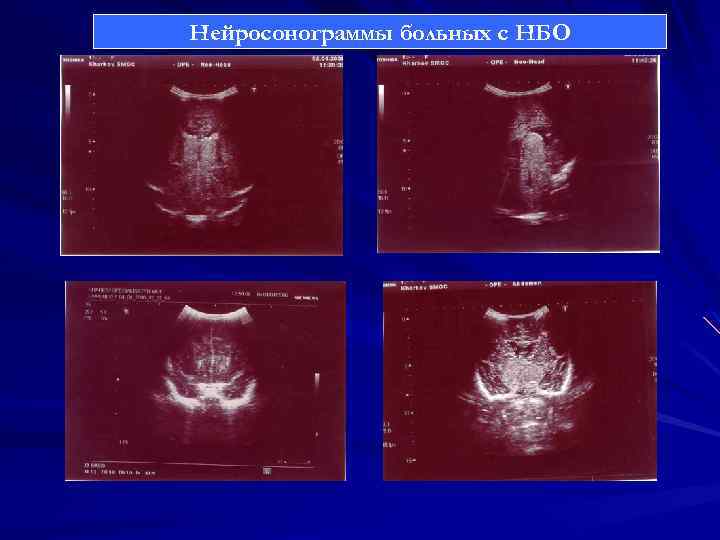 Нейросонограммы больных с НБО 