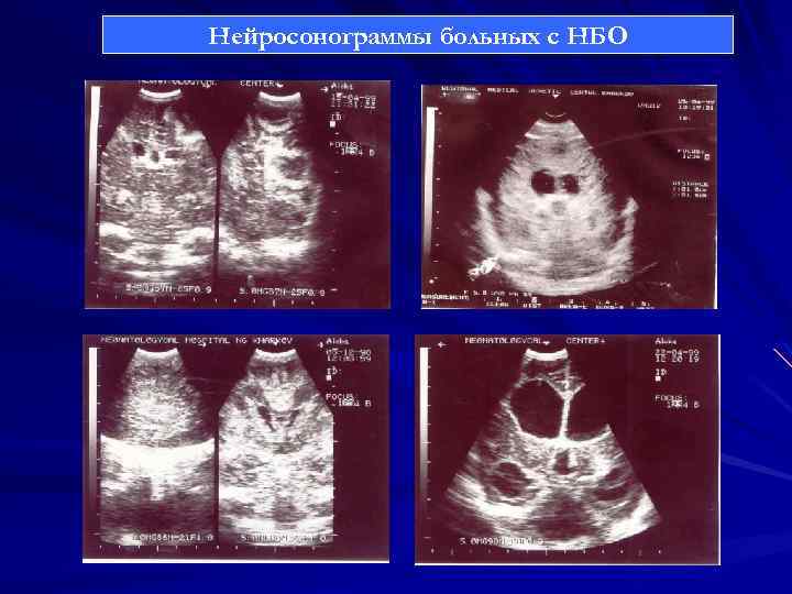 Нейросонограммы больных с НБО 
