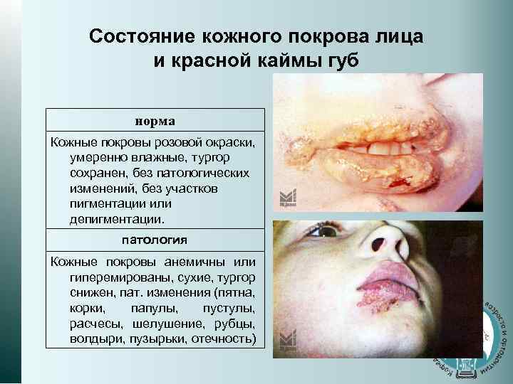Состояние кожного покрова лица и красной каймы губ норма Кожные покровы розовой окраски, умеренно
